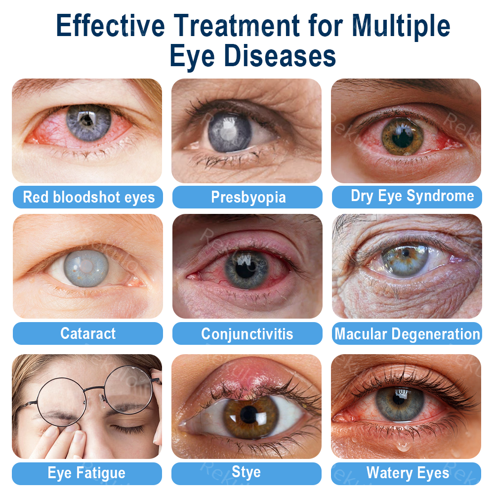 OptiMist Eye Spray✅Approved (For dry eyes, blurry vision, eye strain, presbyopia, and cataracts) 👀 🌿